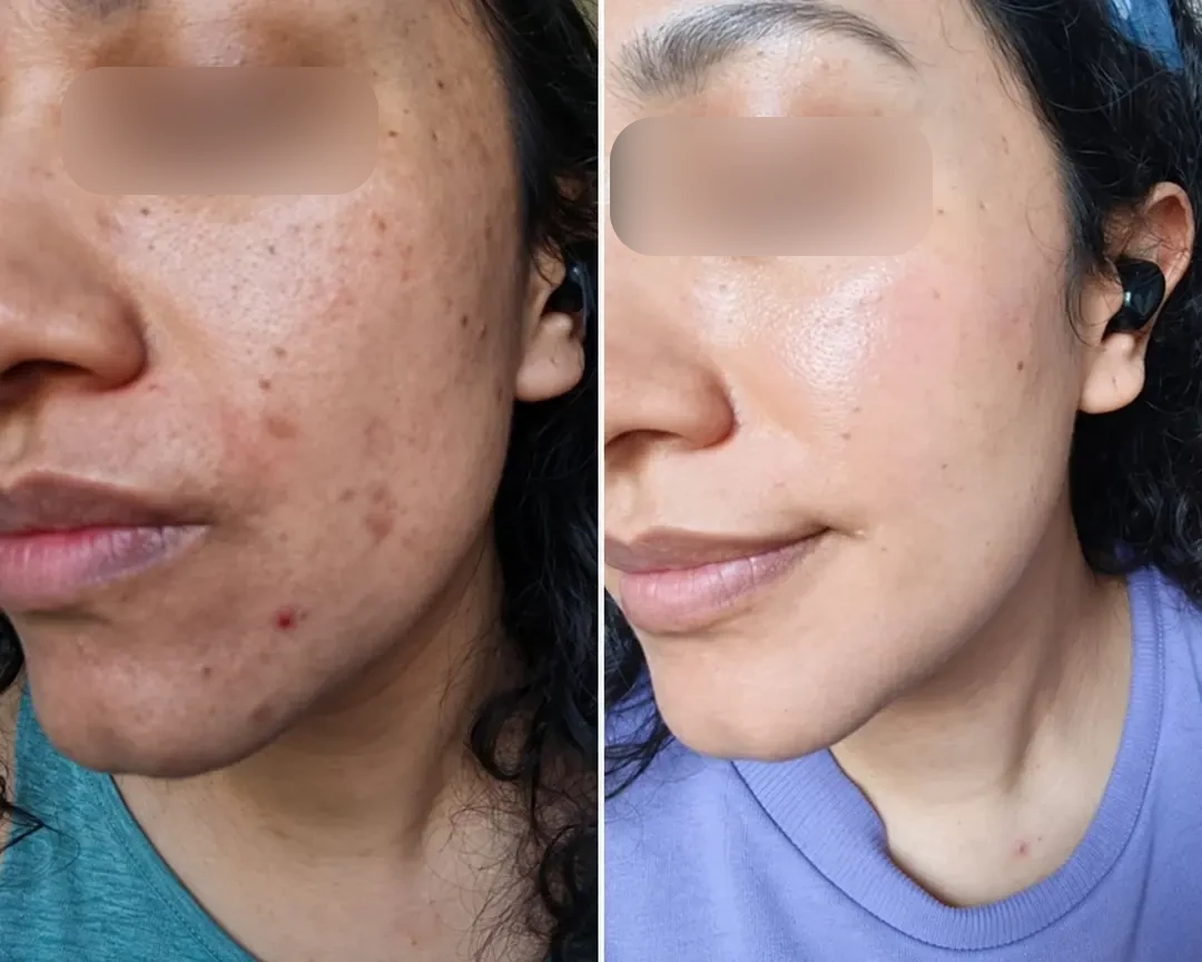 Foto de una clienta antes y después de usar el sérum Pepfine